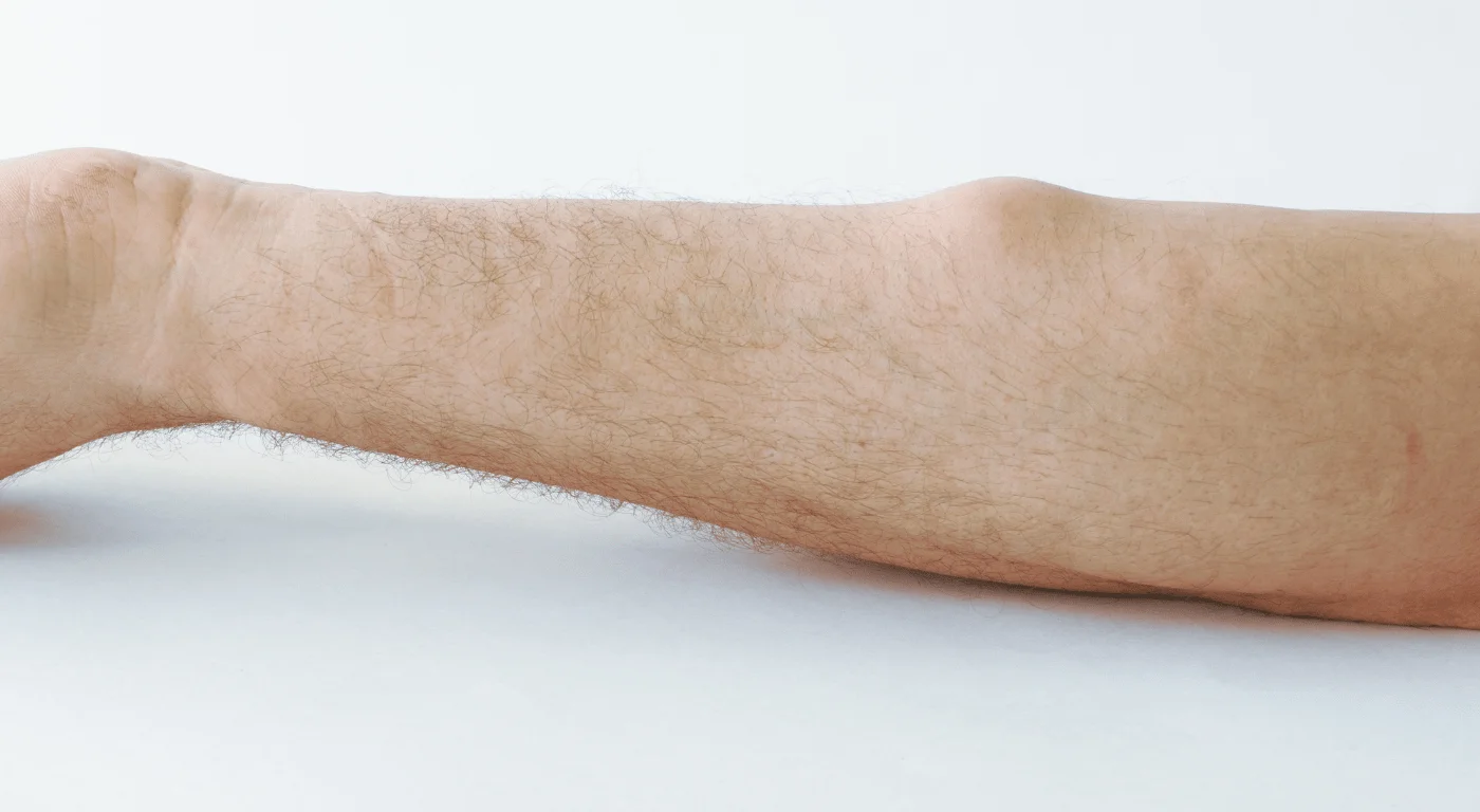 yağ bezesi belirtisi